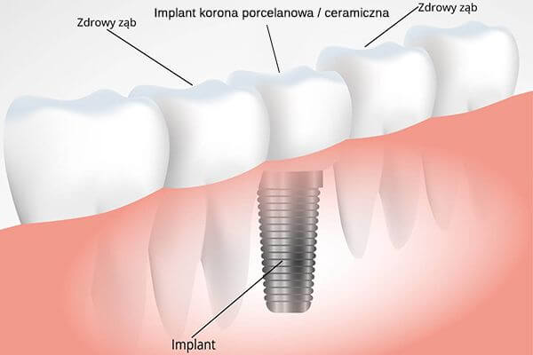 Wykres przedstawiający implant zębów