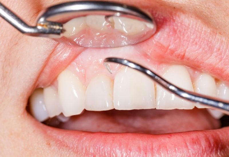krwawiące dziąsła zęby dentysta